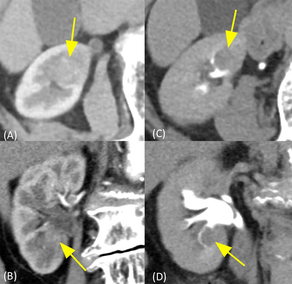 Urothelial Carcinoma